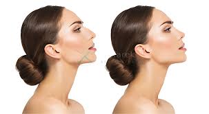 Discover the Beauty of Confidence: Nose Job in Dubai – What You Need to Know 1 image