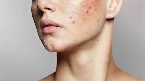 Say Goodbye to Acne Scars: Simple Treatments That Work 1 image 3